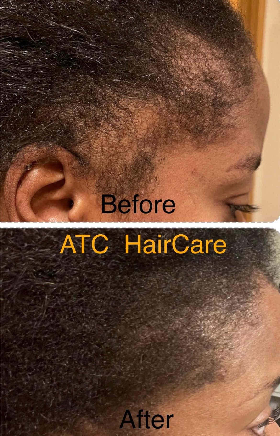 More Hair Therapy Solution-Extra Strength